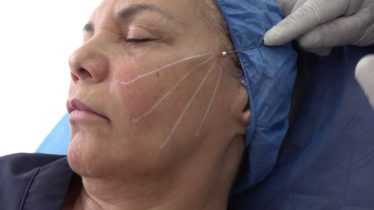 Hilos Tensores — Óvalo facial